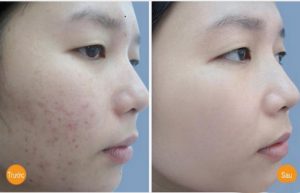 Kem-tri-mun-Neutrogena-On-The-Spot-Acne-Treatment-21g-cua-my-7