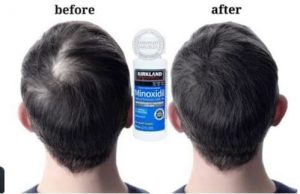 review-thuoc-moc-toc-minoxidil-5-co-tot-khong-su-that-tu-chuyen-gia2