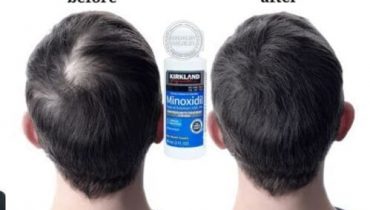 Review thuốc mọc tóc minoxidil 5% có tốt không? Sự thật từ chuyên gia