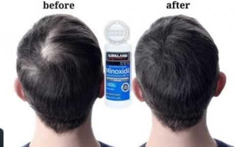 Review thuốc mọc tóc minoxidil 5% có tốt không? Sự thật từ chuyên gia